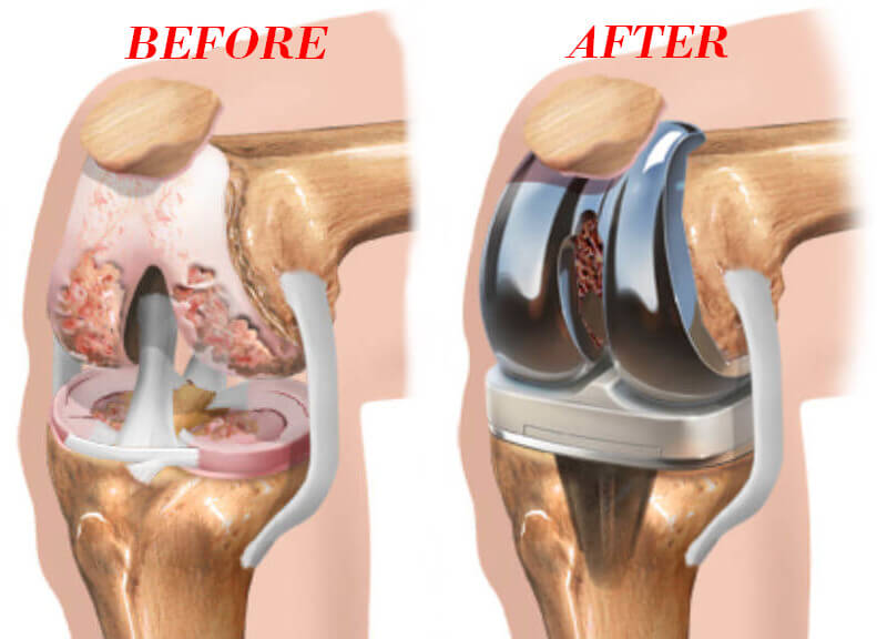 Robotic knee replacement Perth.