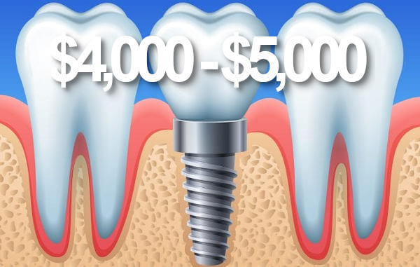 Price dental implants-Perth.